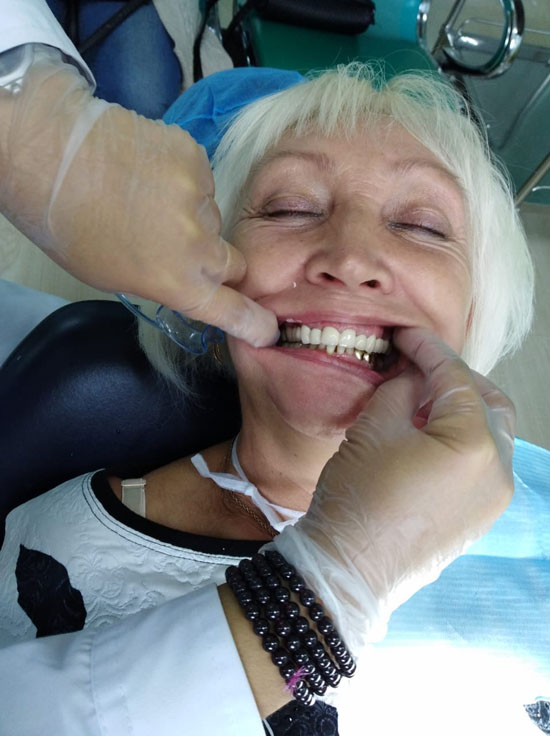после протезирования зубов 